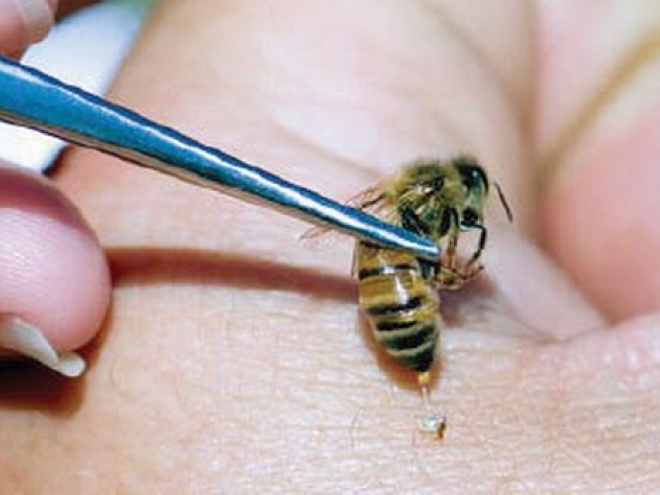 Bee Venom Therapy